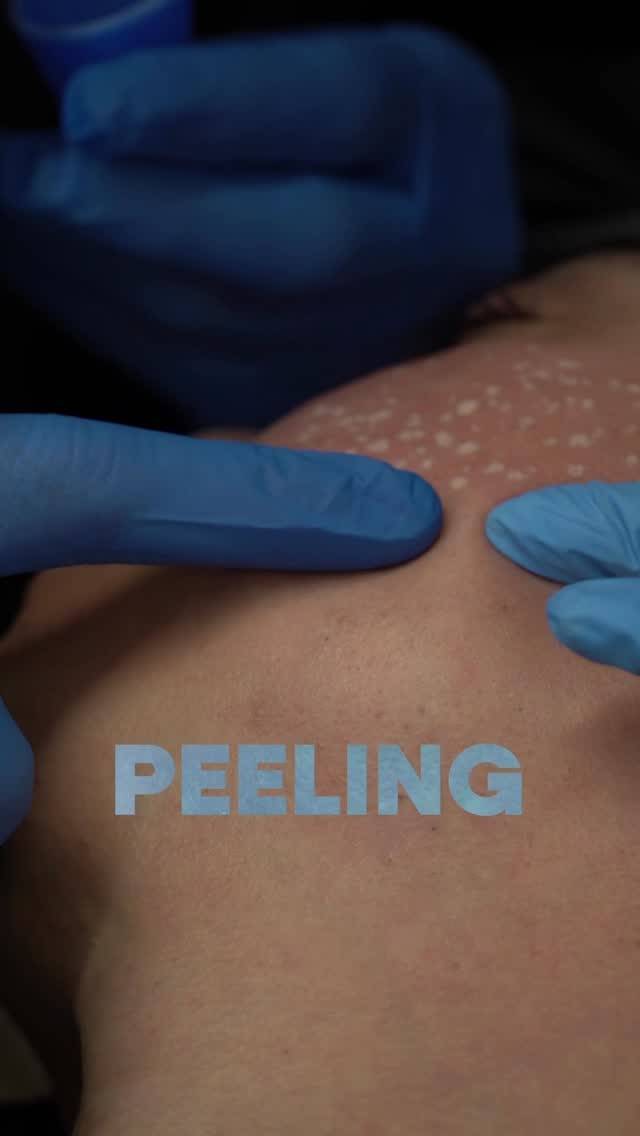 Aplicação de peeling no dorso durante a Imersão